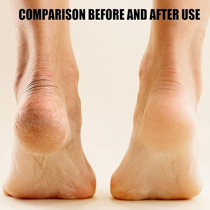 Electronic Pedicure Tool | Cordless Callus & Foot Care Device - Nyara